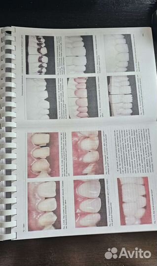 Керамические виниры Галип Гюрель