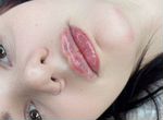 Контурная пластика ботокс губы косметолог