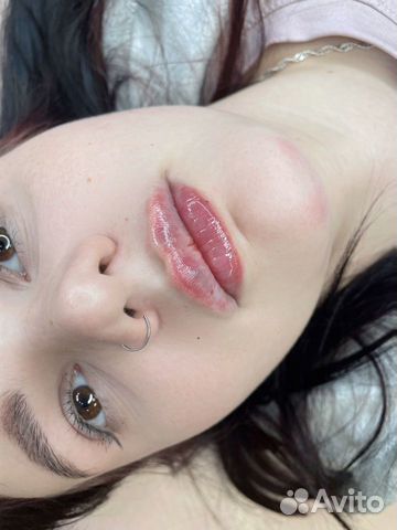 Контурная пластика ботокс губы косметолог объявление продам
