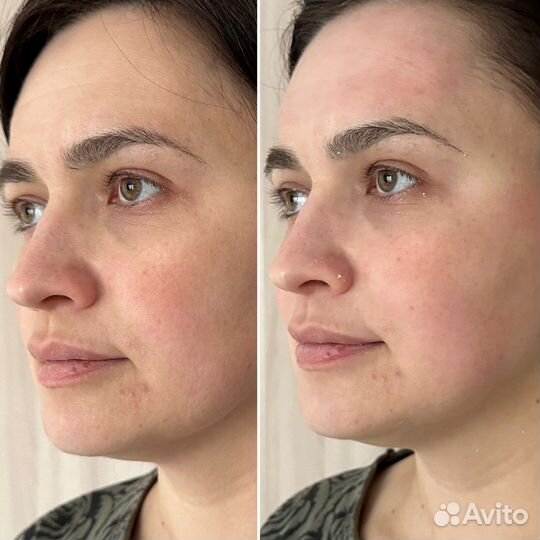 Бмс лица (подтяжка лица, объемные скулы, губы)