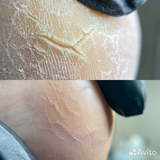 Медицинский педикюр подолог