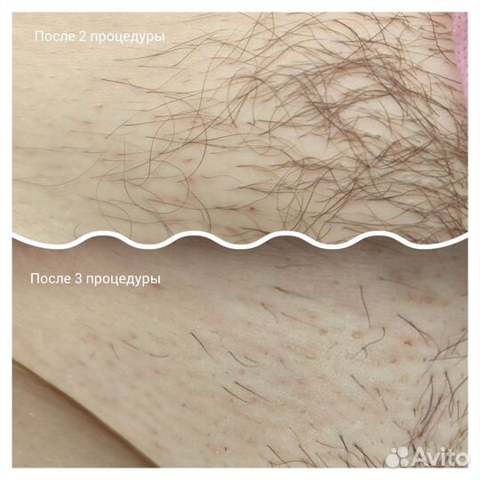 Электроэпиляция Apilus(можно в 4 руки)