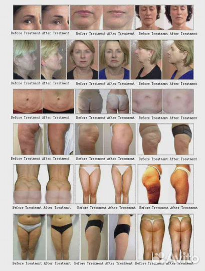 Аппарат портативный Vera Roller. Рассрочка 12 мес