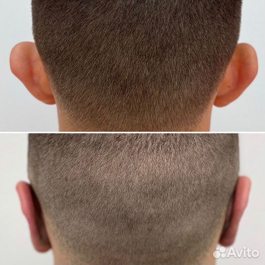 Устранение лопоухости - Отопластика