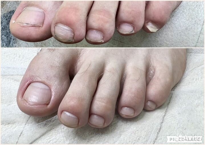 Медицинский педикюр