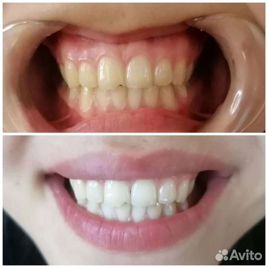 Отбеливание зубов