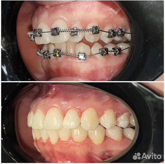 Брекеты