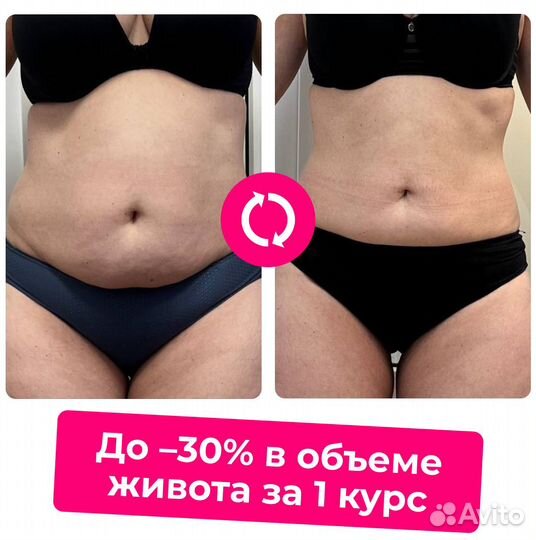 Криолиполиз. Убирает лишние сантиметры без диет