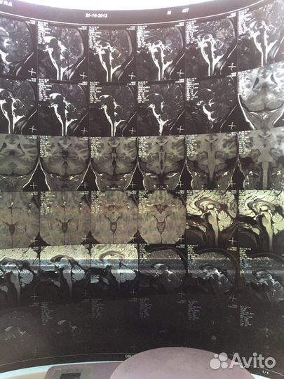 Снимок мрт головного мозга