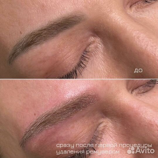 Удаление татуажа ремувером revivink plus ревайвинк