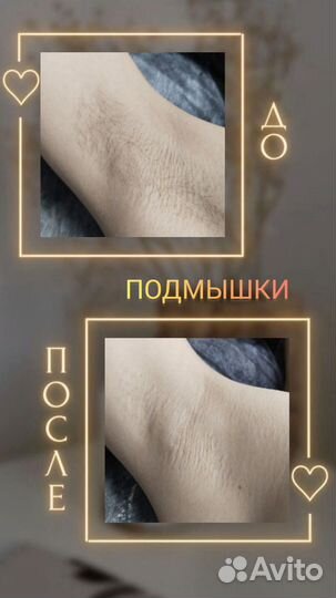 Восковая депиляция