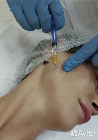 Липолитики лицо тело