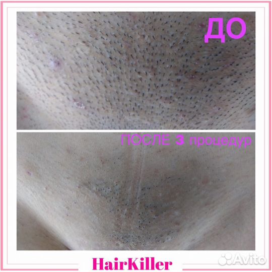 Лазерная эпиляция. Диодный лазер. Медобразование