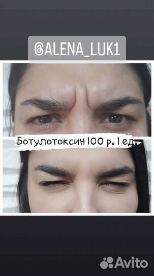 Ботокс требуются модели