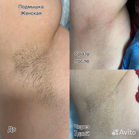 Электроэпиляция