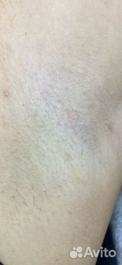 Электроэпиляция