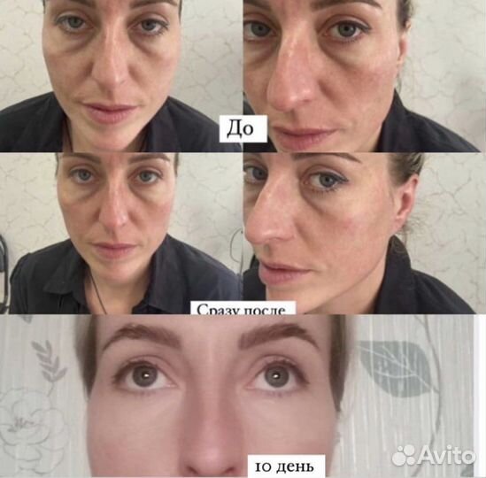 Смас лифтинг