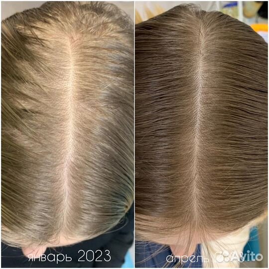 Трихолог лечение волос