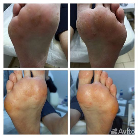 Лечебный педикюр подолог