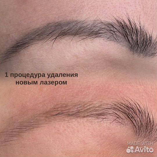 Удаление татуажа Брови/губы/стрелки Лучший Лазер