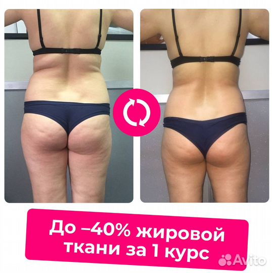 Криолиполиз. Эффективно борется с лишним жиром