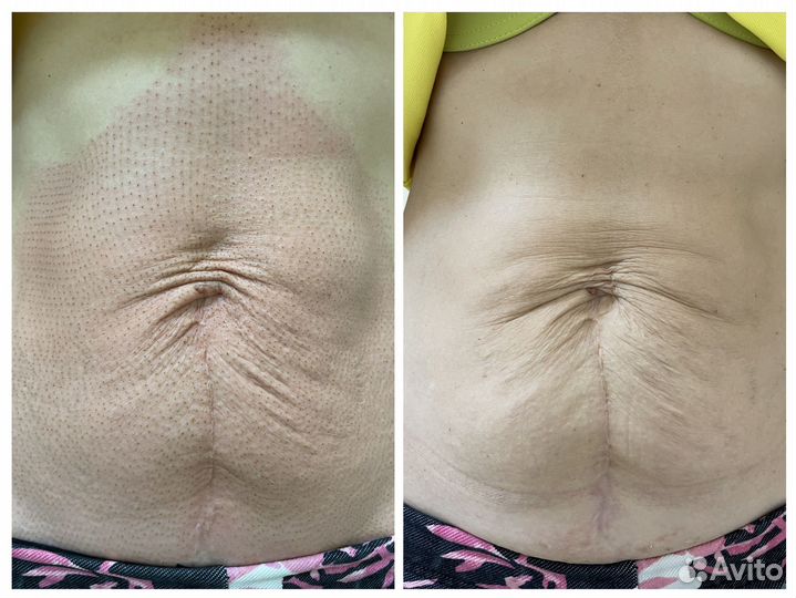 Омоложение кожи горячей плазмой, подтяжка кожи