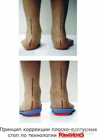 Индивидуальные ортопедические стельки