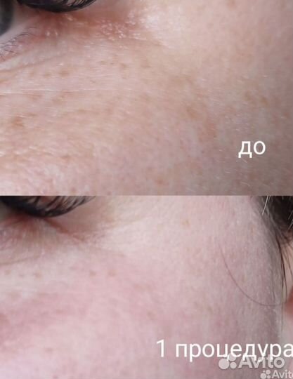 Аппарат для омоложения