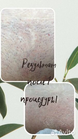 Элос-эпиляция: глубокое бикини