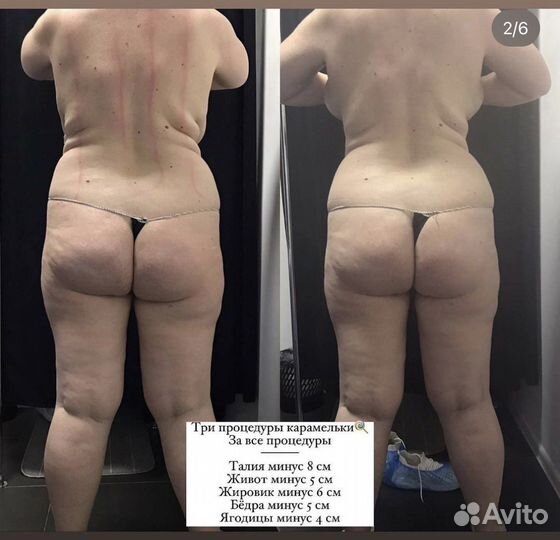 Карамельная липосакция