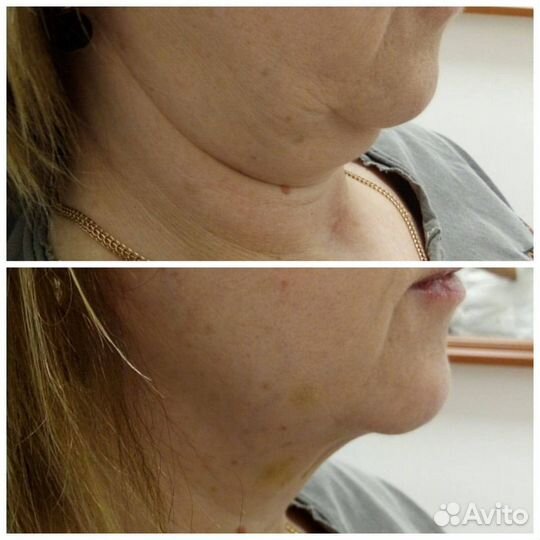 Похудение. Безоперационная липосакция. Целлюлит