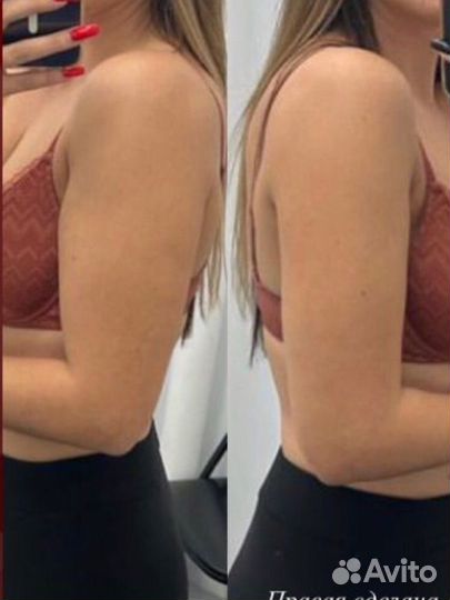 LPG массаж похудение антицеллюлитный массаж