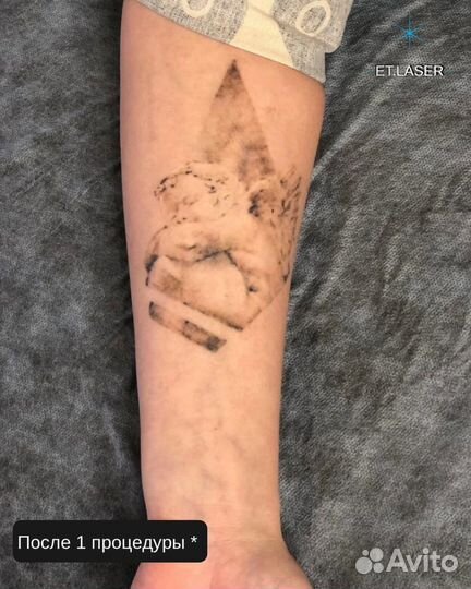 Лазерное удаление татуировок