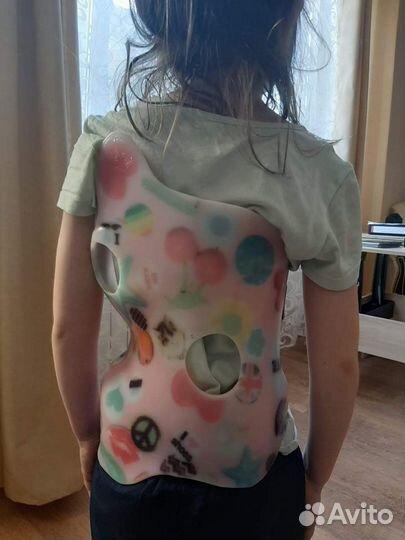 Корсет - Орто лечение сколиоза корсетом Шено