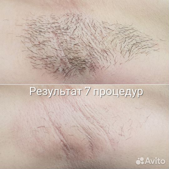 Электроэпиляция