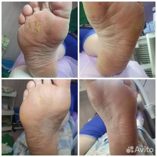 Педикюр всех видов