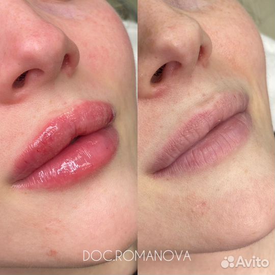 Косметолог. Увеличение губ