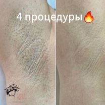 Лазерная эпиляция, Санкт-Петербург