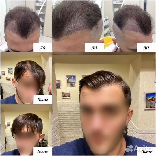 Пересадка волос FUE micro