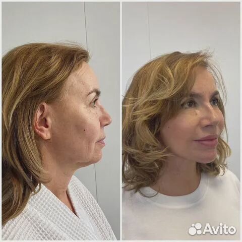 Подтяжка лица за 1 процедуру Эффект сразу