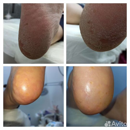 Лечебный педикюр подолог