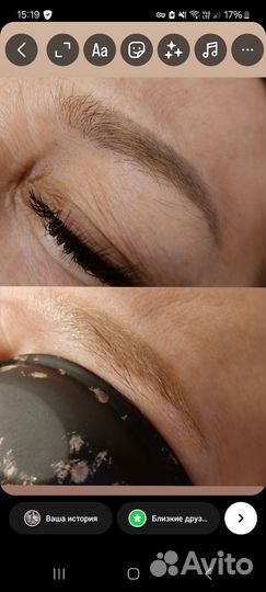 Лазерное удаление татуажа