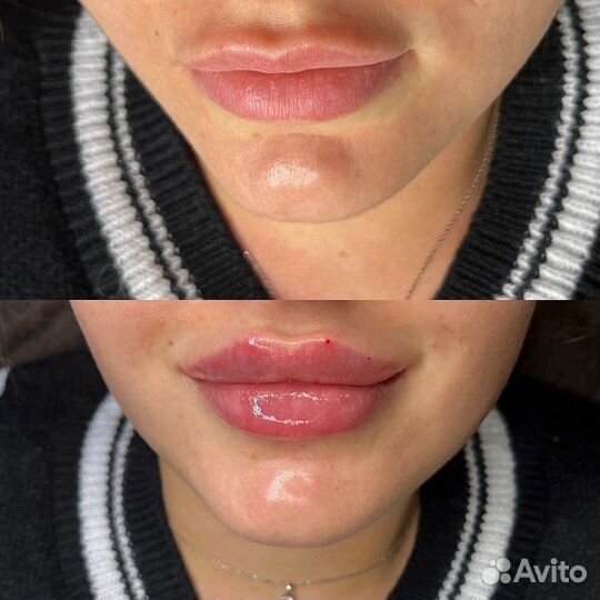 Модель на увеличение губ