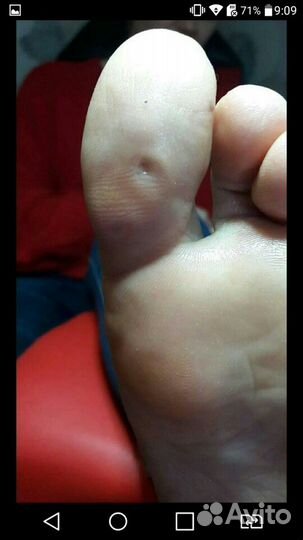 Медицинский педикюр.Подолог. Эстет педикюр