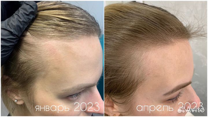 Трихолог лечение волос