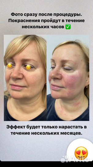 Подтяжка лицаи шеи