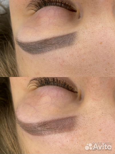 Лазерное удаление татуажа