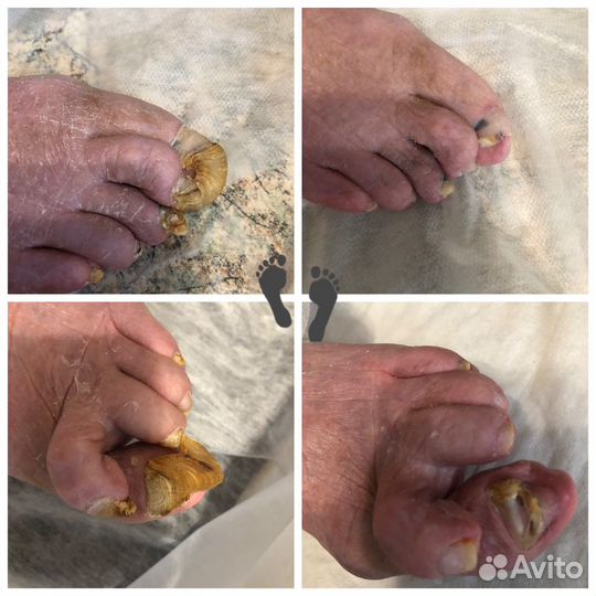 Подологическая зачистка. Подолог с выездом на дом