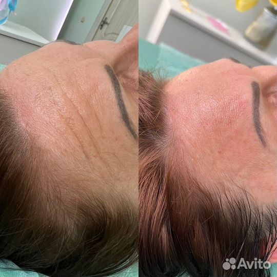 Аппаратный массаж лица