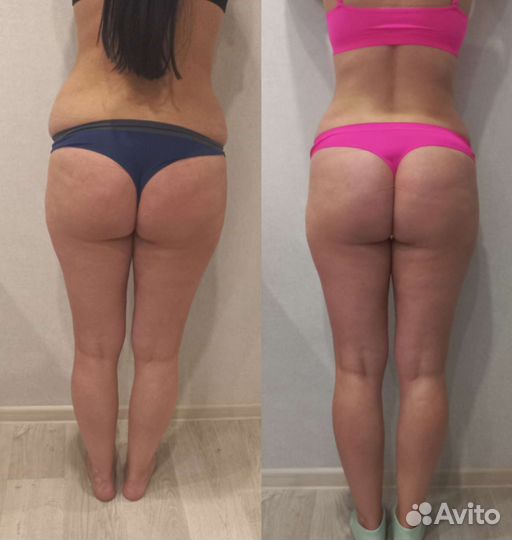 Антицеллюлитный ручной массаж, RFлифтинг,кавитация